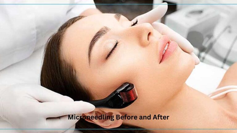 Microneedling Before and After Intro, Treatment, Work procedure, Signs, Radiofrequency, Hyperpigmentation